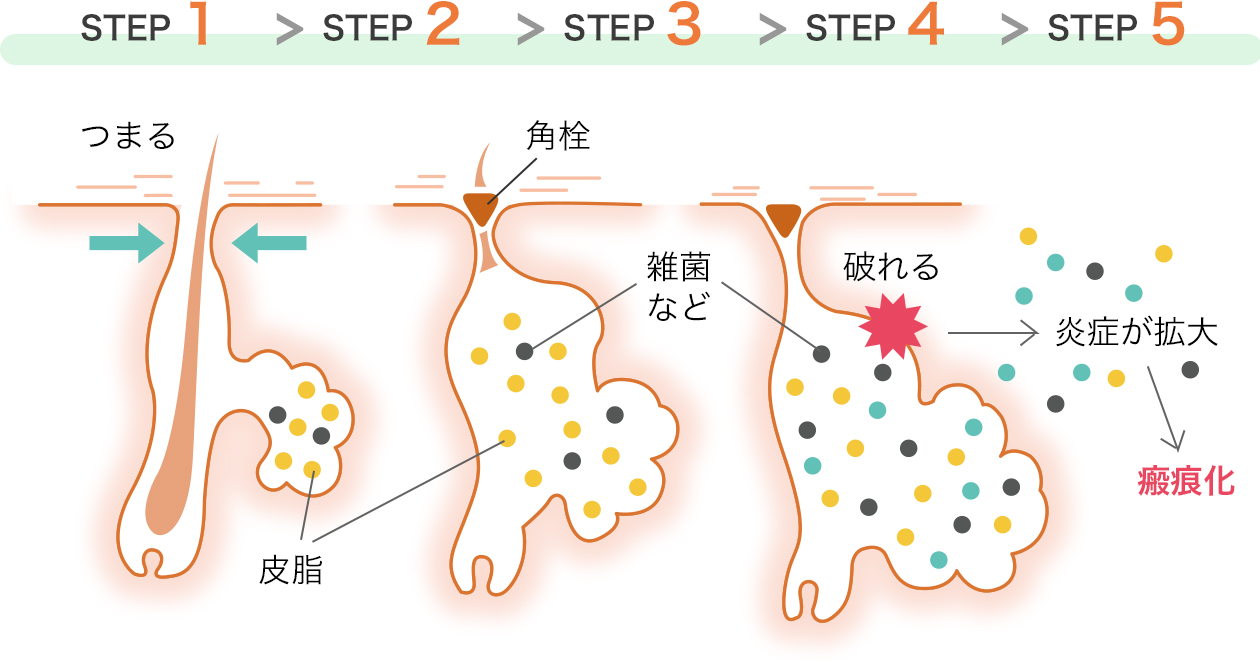 そもそも「にきび」とは?